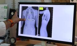 Uzmandan ailelere uyarı: Skolyoz ağrı vermeden ilerleyebilir