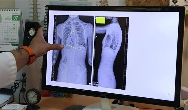 Uzmandan ailelere uyarı: Skolyoz ağrı vermeden ilerleyebilir
